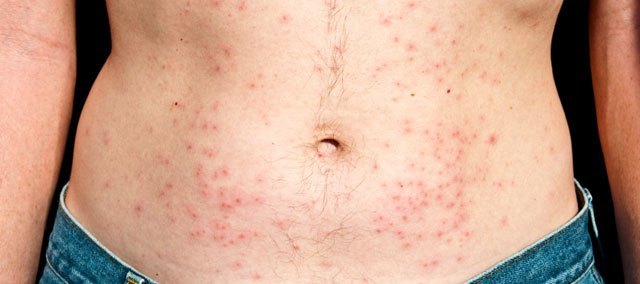 Hot tubs can cause rash called hot tub folliculitis